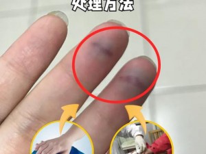 宝宝手指被门夹了怎么办？