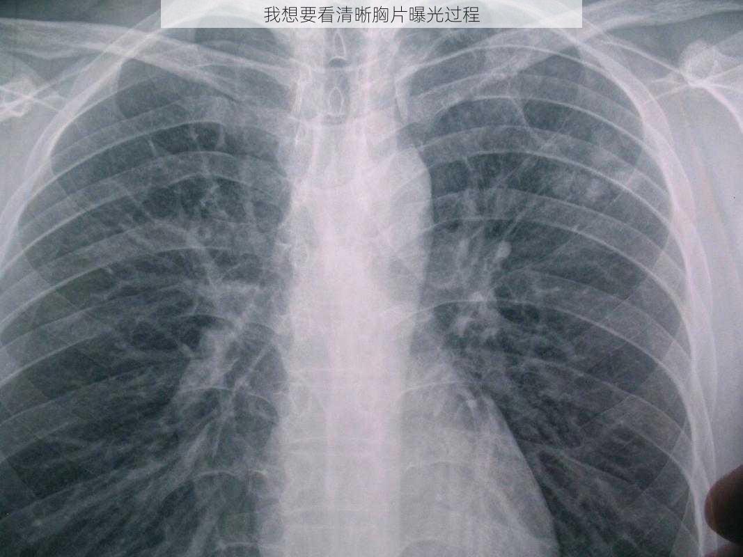 我想要看清晰胸片曝光过程